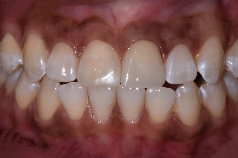 Chipped and worn upper front teeth rebuilt with composite bonding, close-up view: after treatment