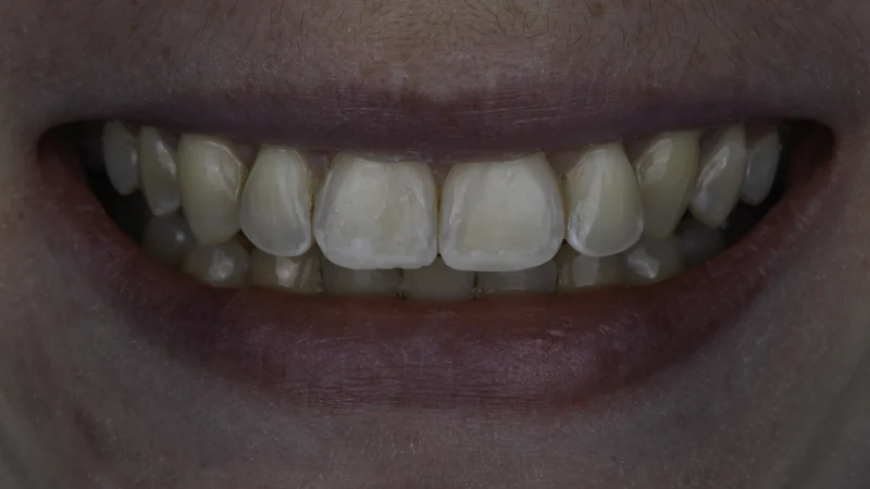 Overlapping front teeth straightened with clear aligner therapy, close-up view: after treatment