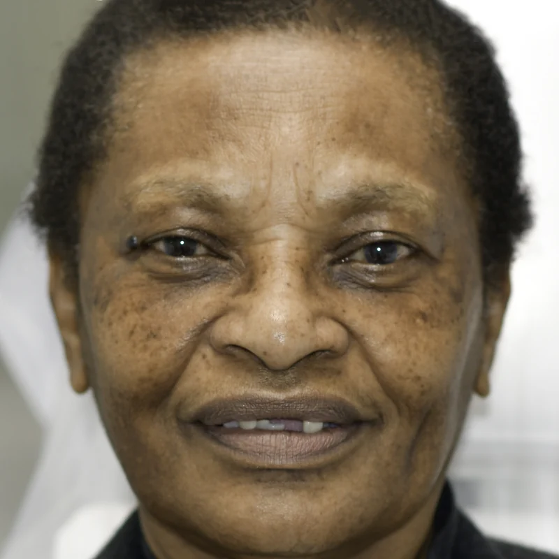 Failing dentition replaced with fixed full-arch implant teeth, full smile view: before treatment