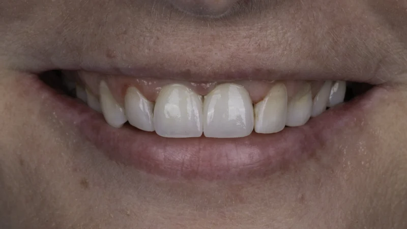 Dark, aging front crowns renewed with implant restorations, smile view: after treatment