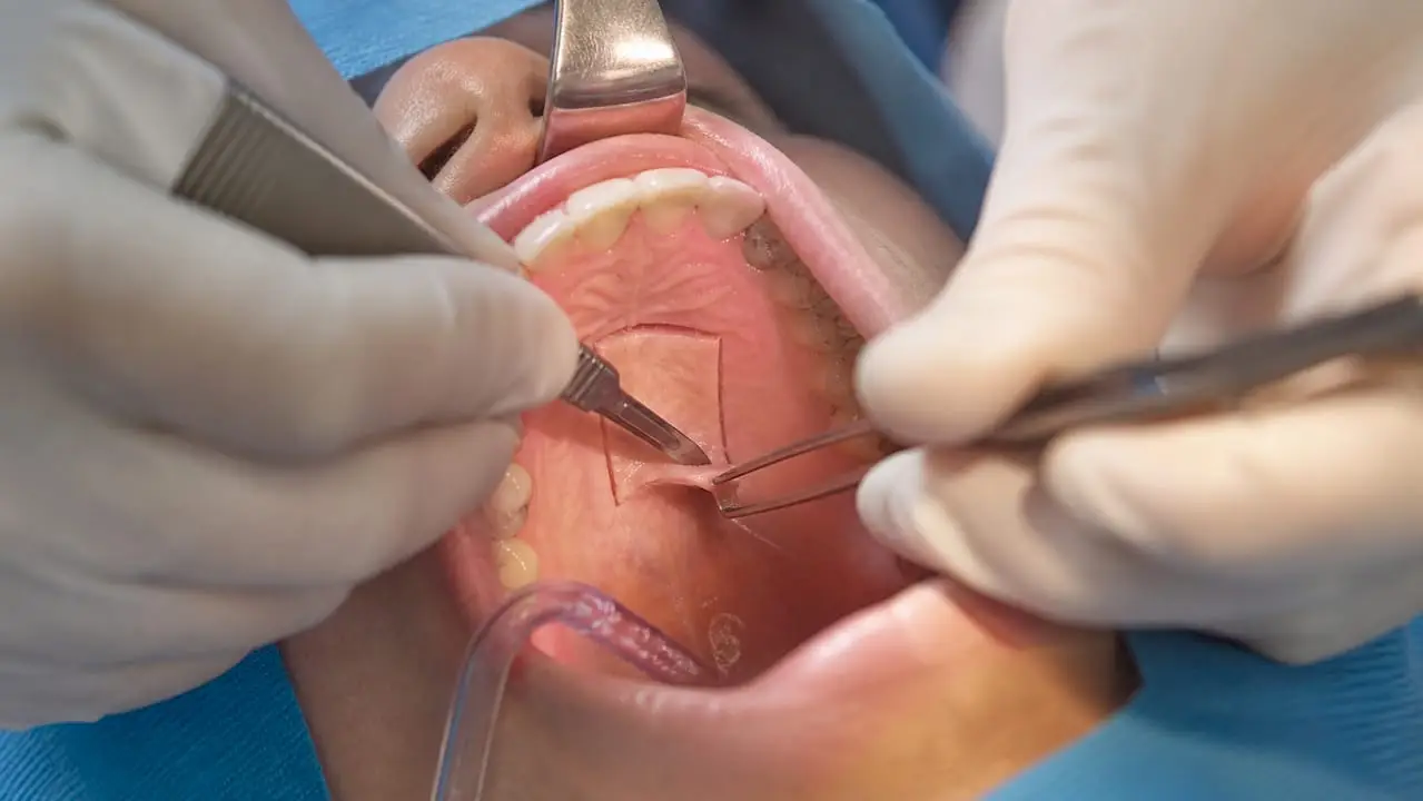 Hands harvesting connective tissue graft from palate