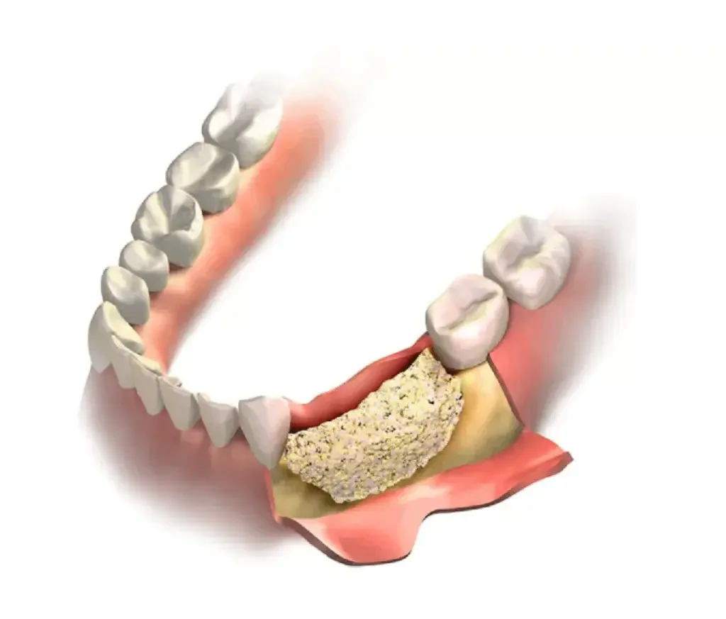 Illustration of bone graft material placed in a mandibular ridge defect