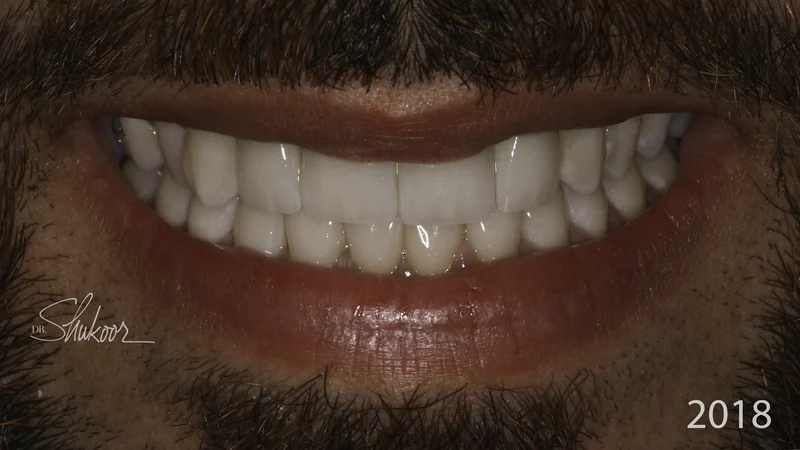 Mismatched Front Teeth Evened Out With Veneers, close-up view: after treatment