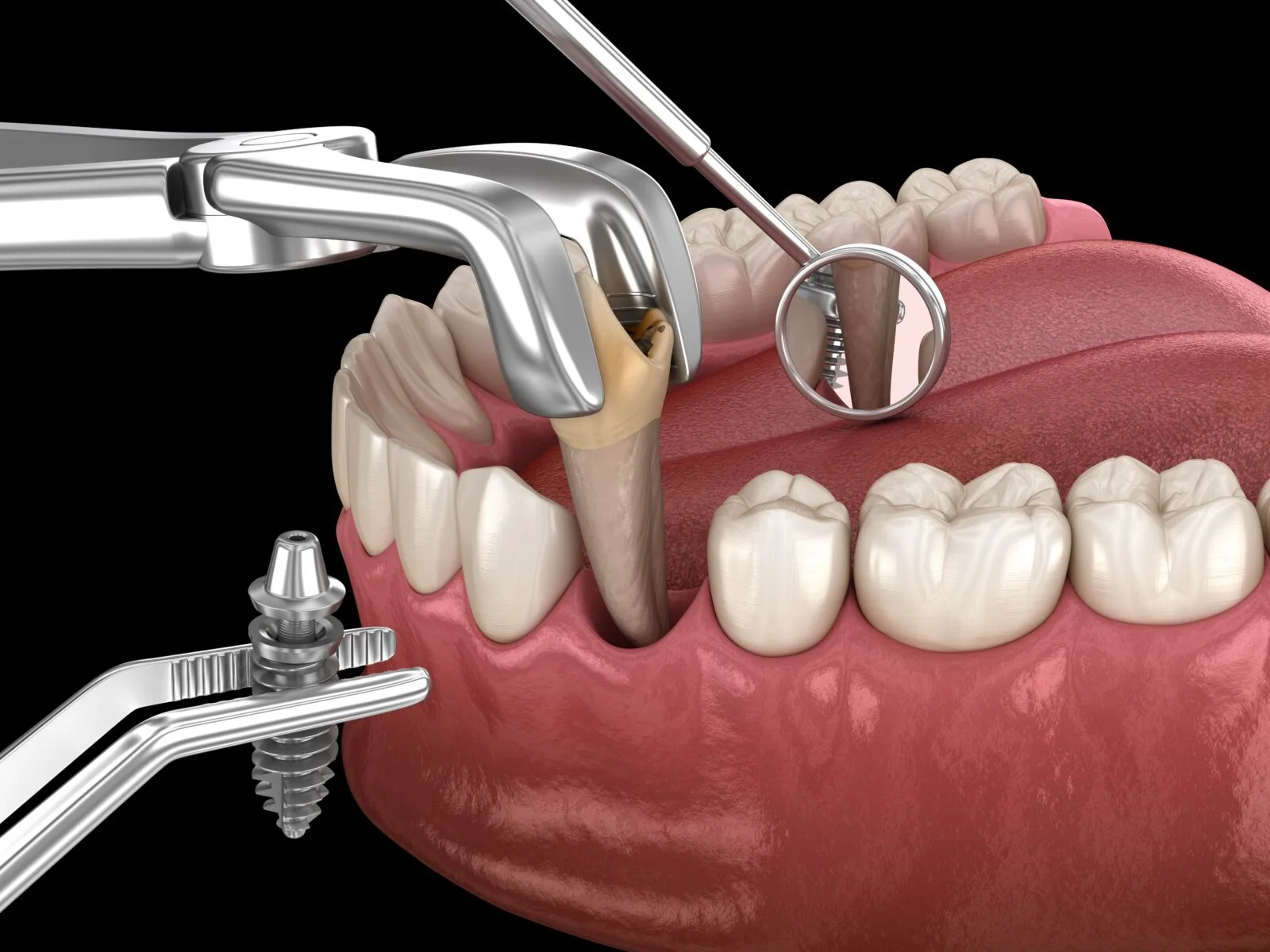 Illustration of extraction forceps and an implant during single-tooth replacement