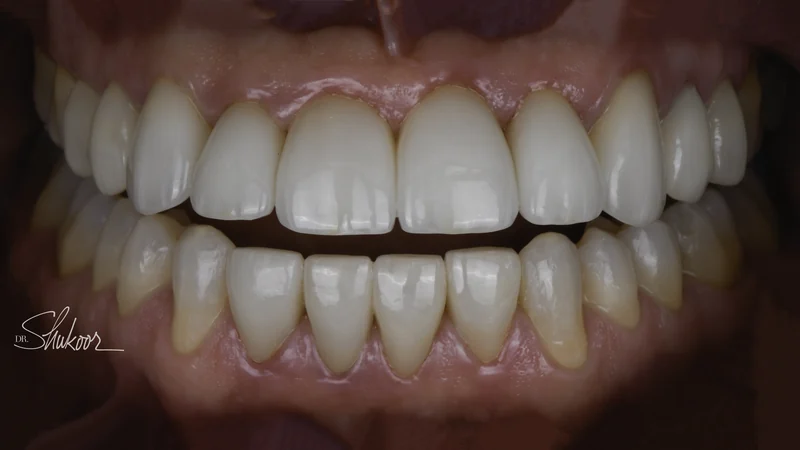 Narrow, Spaced Teeth Reshaped With a Full Veneer Smile, close-up view: after treatment