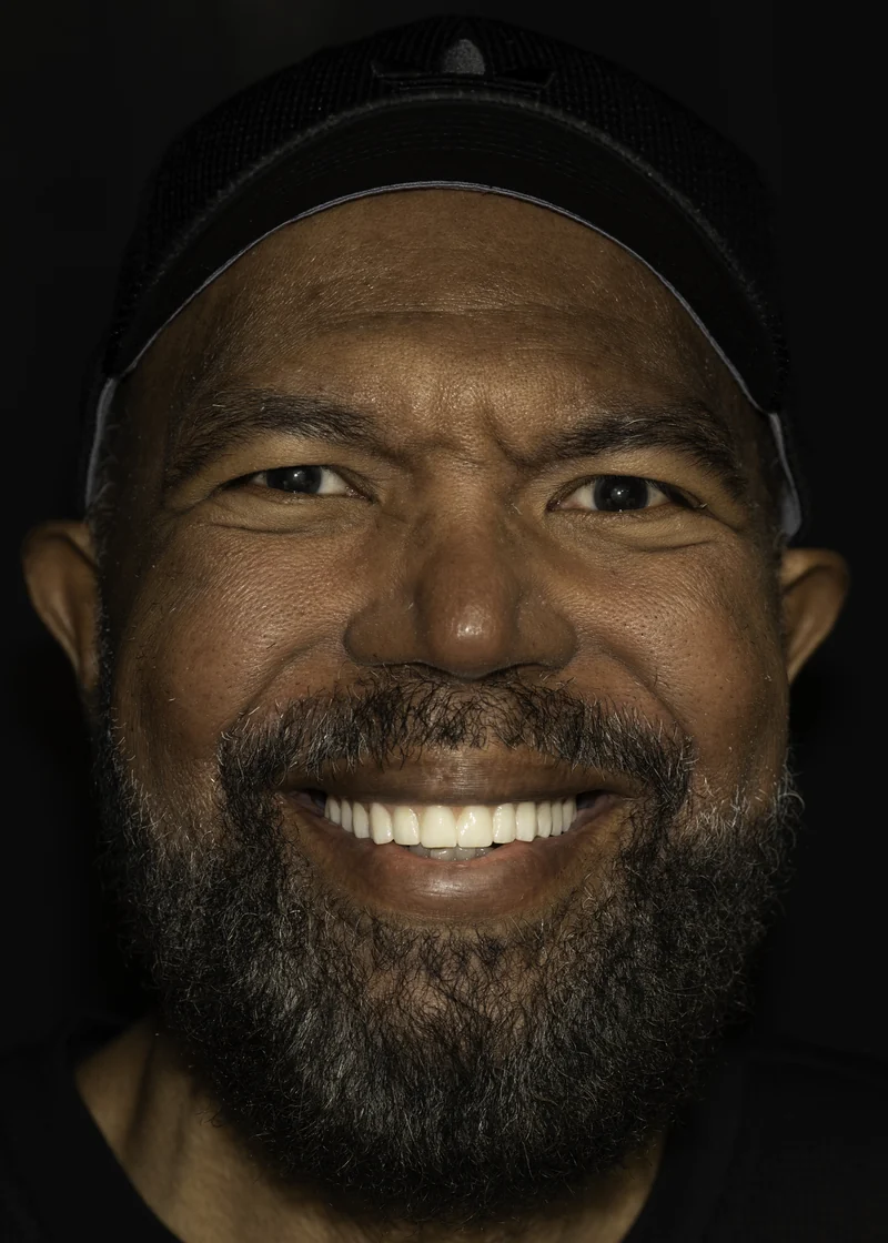 Broken-down teeth rebuilt with full-arch implant restoration, smile view: after treatment