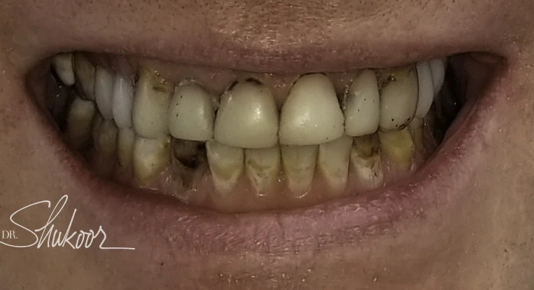 Smile makeover brightens and evens worn front teeth, close-up view: before treatment