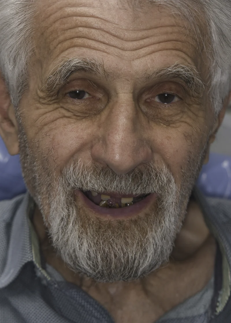 Complete upper and lower reconstruction on dental implants, portrait view: before treatment