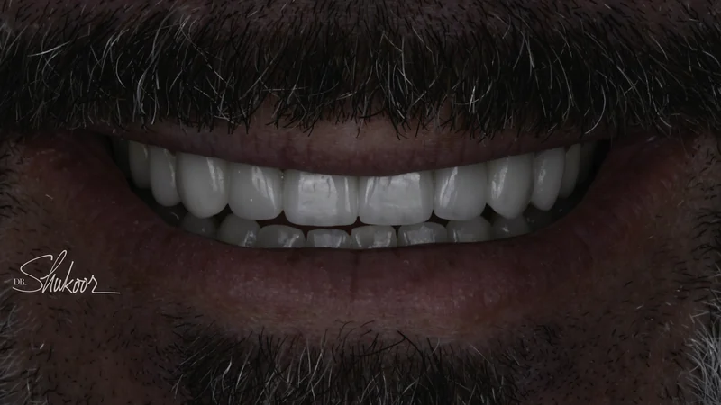 Worn, discolored smile rebuilt with a complete smile makeover, smile view: after treatment