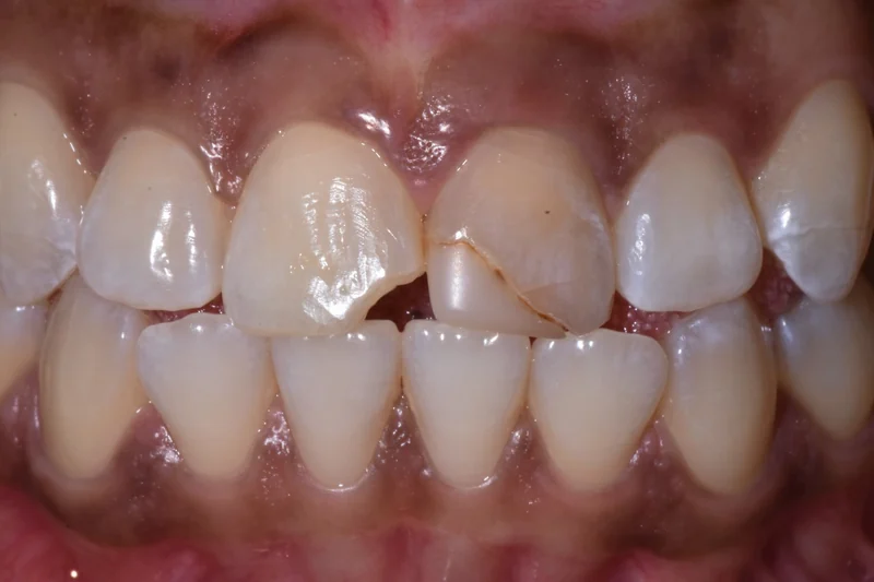 Chipped and worn upper front teeth rebuilt with composite bonding, close-up view: before treatment