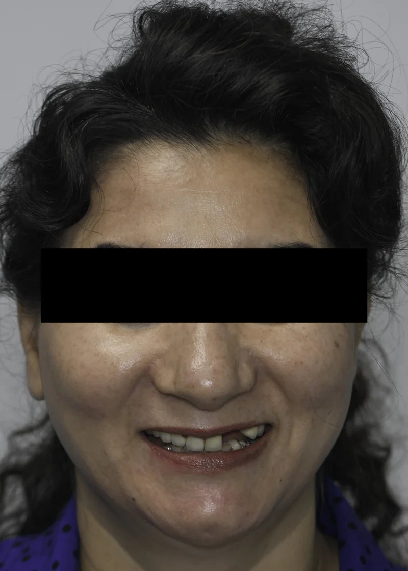 Missing tooth replaced with a single dental implant and crown, full smile view: before treatment