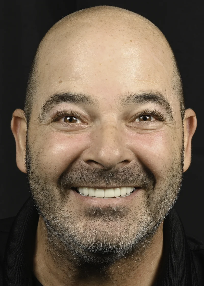 Worn, discolored dentition restored with full-arch implants, smile view: after treatment