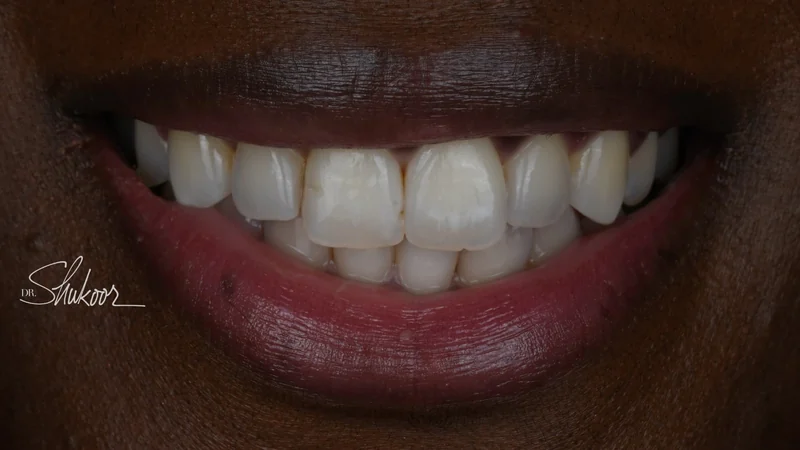 Crowded upper and lower front teeth aligned with clear aligners, close-up view: after treatment