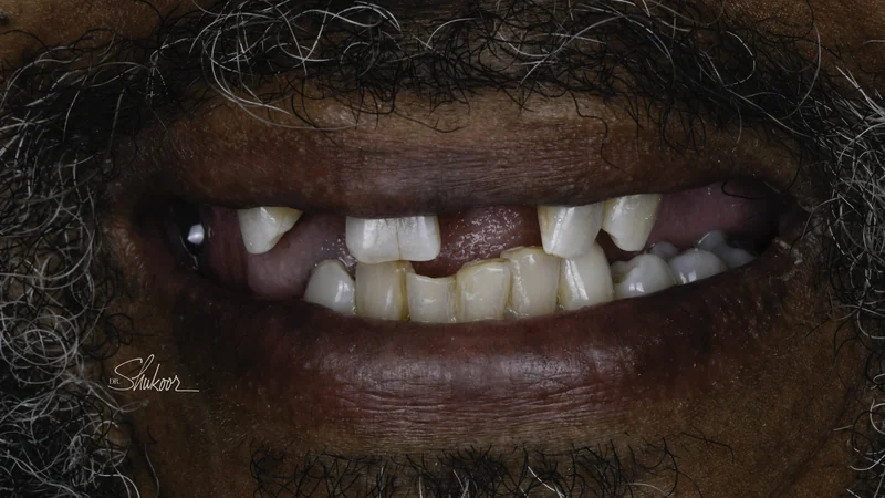 Missing front tooth replaced immediately with a dental flipper, close-up view: before treatment