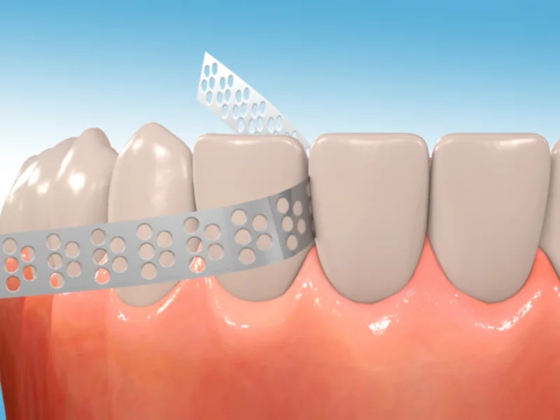 Interproximal reduction strip used between teeth for clear aligner space creation