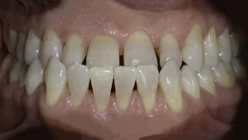 Narrow, Spaced Teeth Reshaped With a Full Veneer Smile, close-up view: before treatment