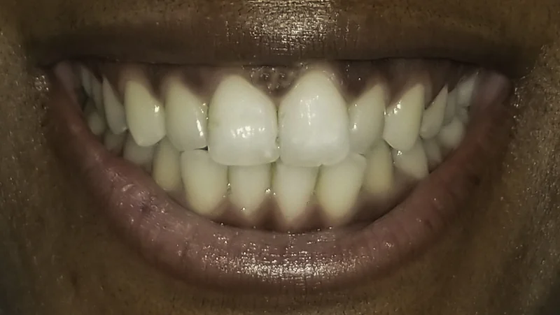 Crowded upper and lower front teeth aligned with clear aligners, close-up view: before treatment