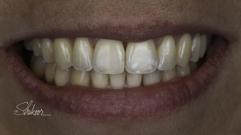 Worn, uneven incisal edges realigned with clear aligners, close-up view: after treatment