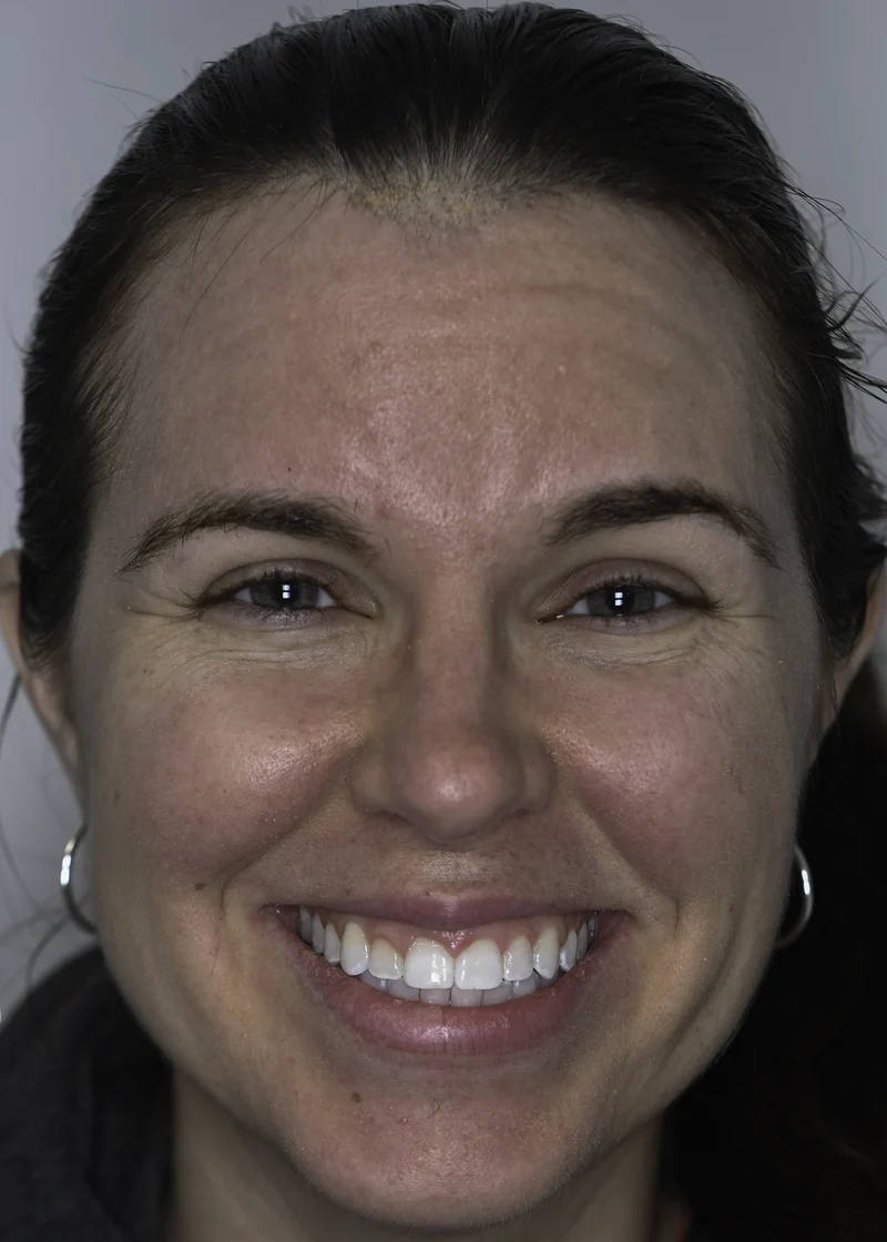 Uneven spacing and rotation corrected with clear aligners, full smile view: after treatment