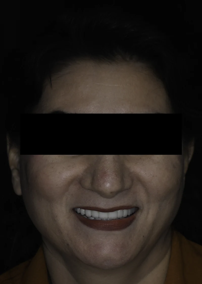 Missing tooth replaced with a single dental implant and crown, full smile view: after treatment