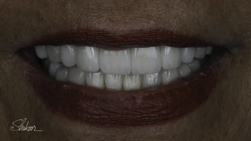 Worn, mismatched restorations rebuilt in a full-mouth rehabilitation, smile view: after treatment