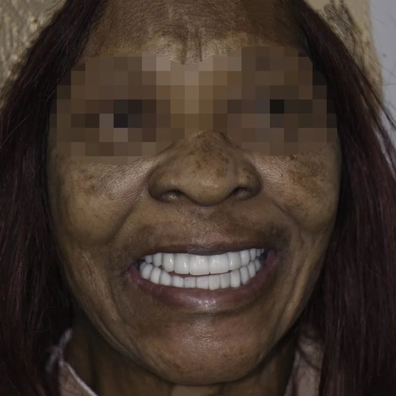 Failing upper teeth replaced with a fixed implant-supported arch, full face view: after treatment