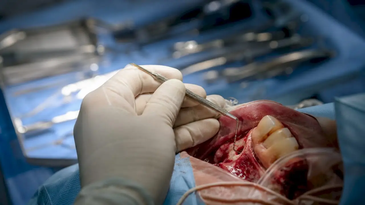 Measuring bone defect with probe in dental surgery