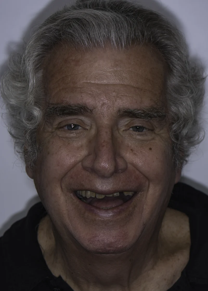 Advanced periodontal breakdown treated with full-arch implants, full face view: before treatment
