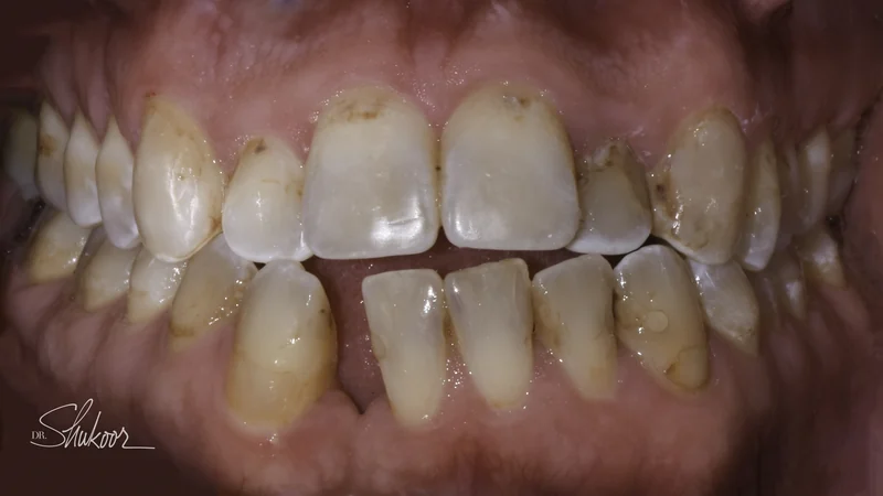 Smile makeover restores symmetry and a healthy shade, full smile view: before treatment