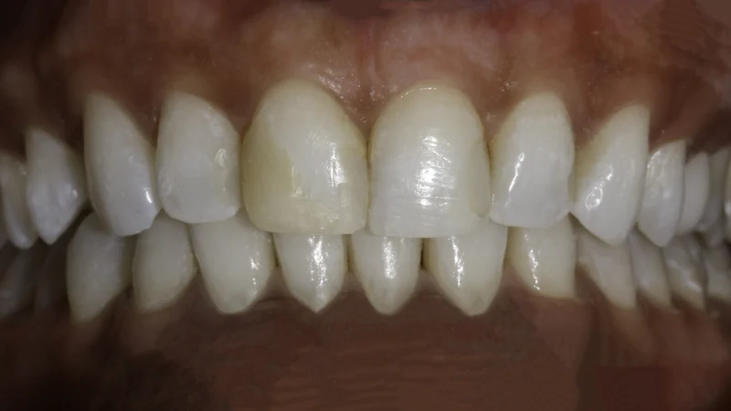 Gap Between Front Teeth Closed With Porcelain Veneers, close-up view: before treatment